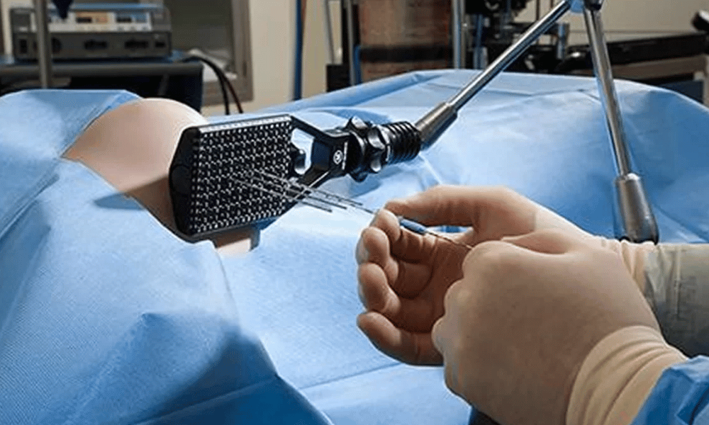 Brachytherapy - Internal Radiation Therapy