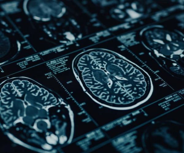 Deep Brain Stimulation in Turkey