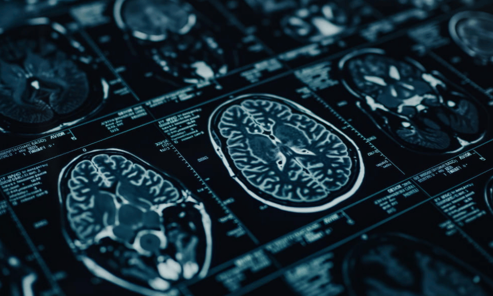 Deep Brain Stimulation in Turkey