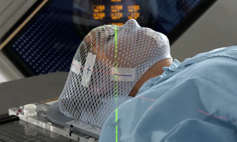 Stereotactic Radiotherapy