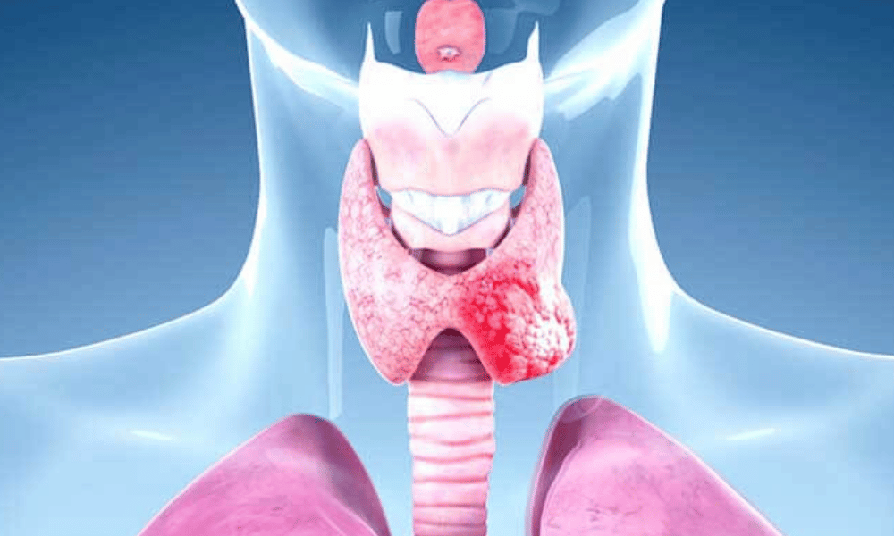 Thyroid Cancer
