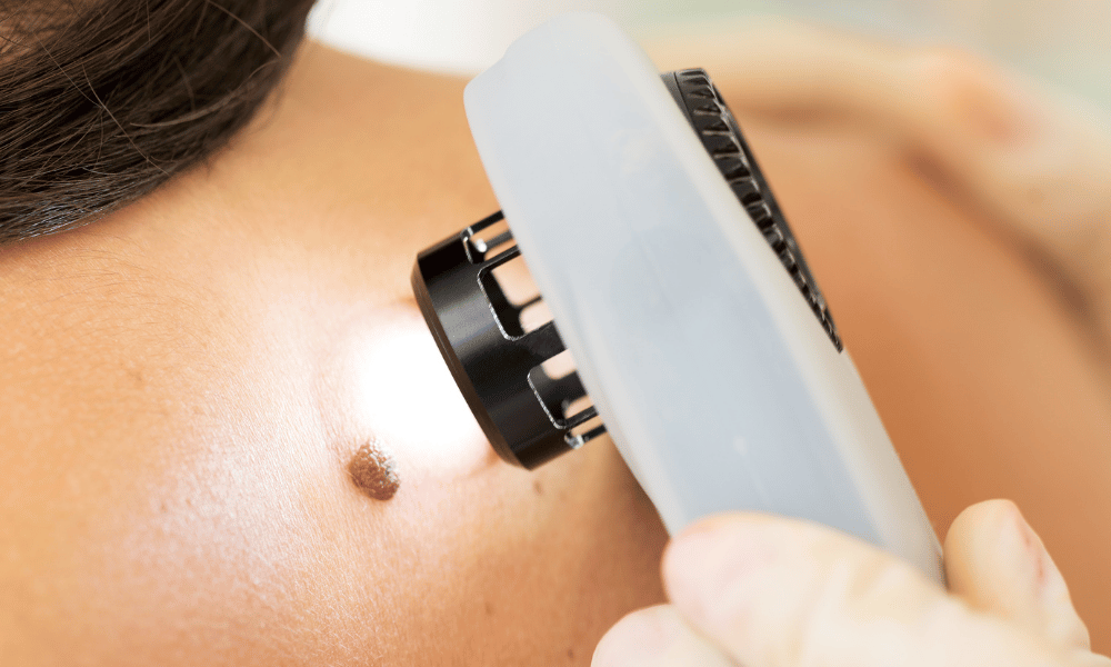 TILs Therapy for Advanced Melanoma