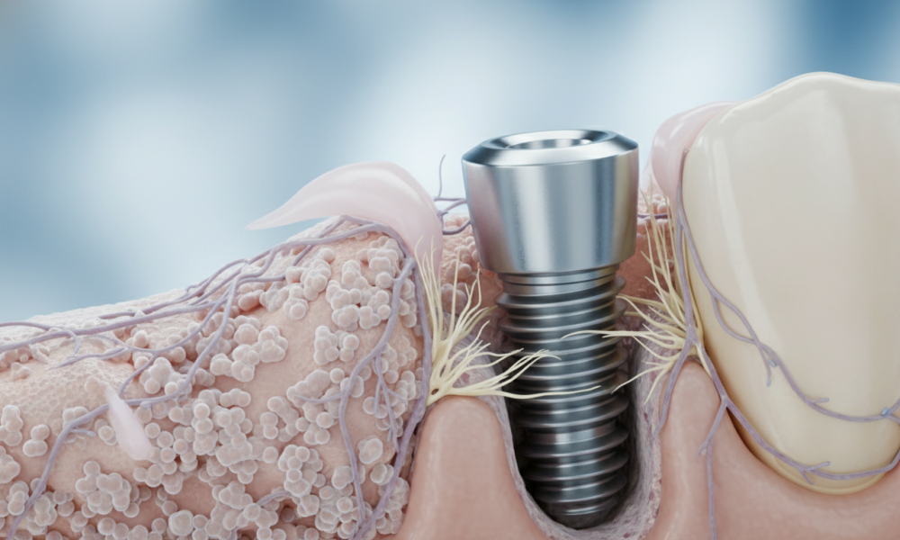 osseointegration jawbone